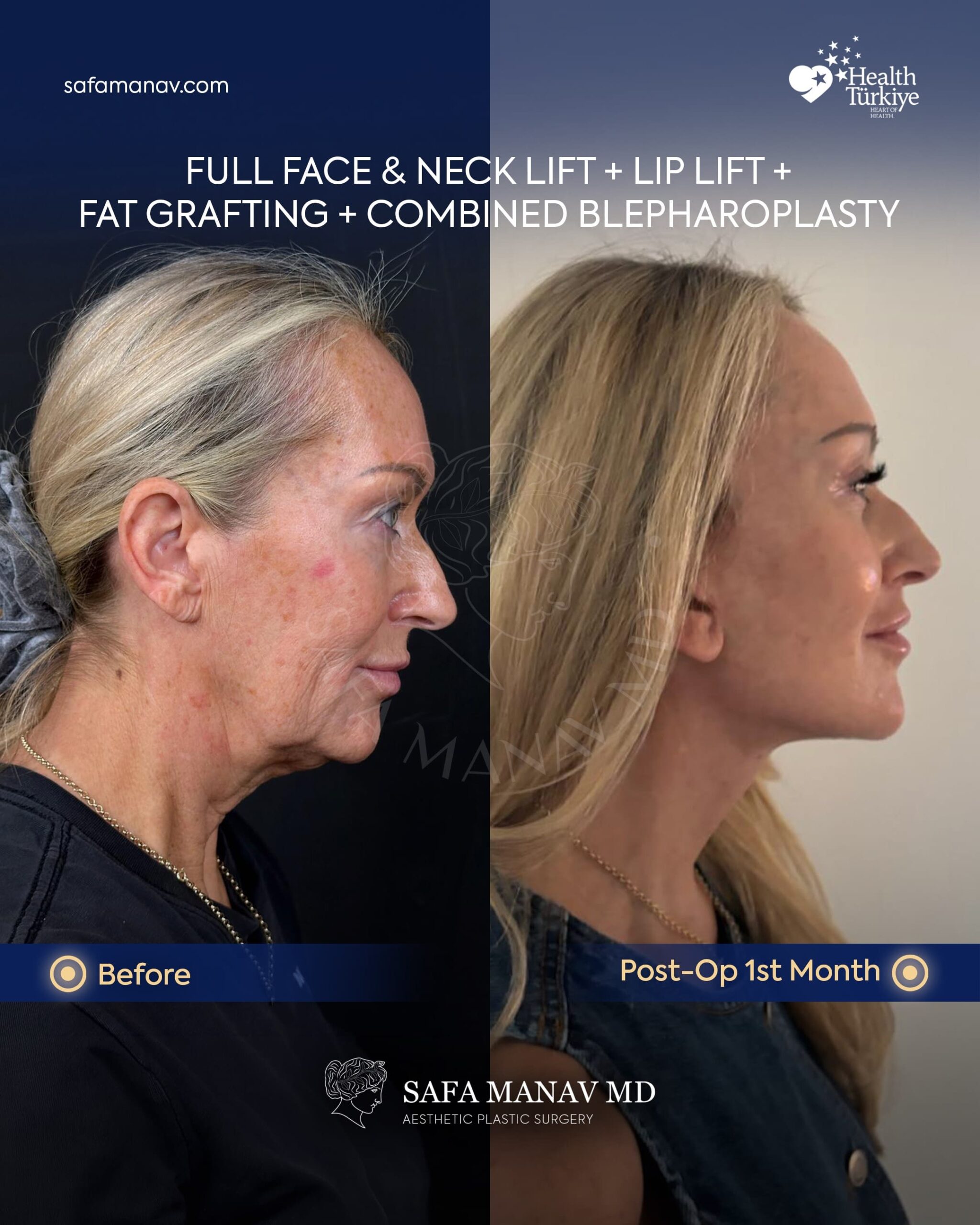 Full face and neck lift with lip lift and blepharoplasty 1 month post-op natural results for USA patient with Dr. Safa Manav Clinic Istanbul