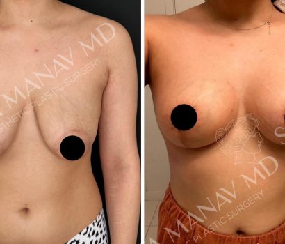 Breast lift with Implants